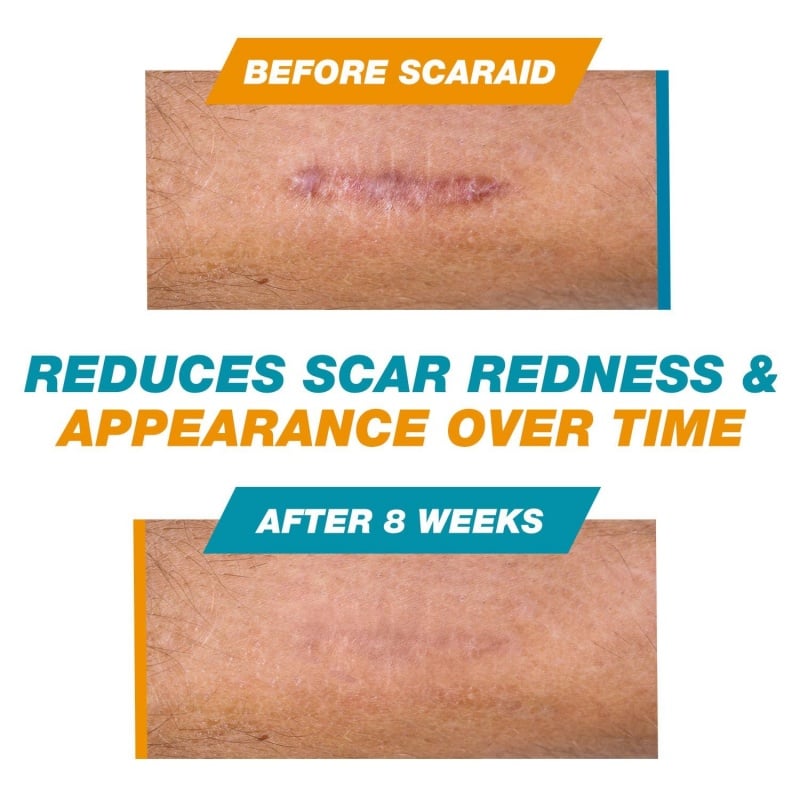 Skin Scar Solutions🛡️ 60% Silicone Scar Stick
