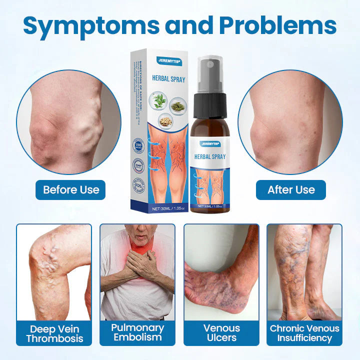 Erase Varicose Veins in Just 7 Days⏱️